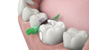 Composi-Tight® 3D Fusion™ Full Curve Matrix Bands
