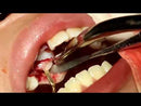 Woodpecker surgic-touch, piezo for bone surgery, endodontic, periodontic, bone function