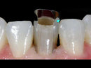 Garrison Fusion™ Anterior Matrix Bands