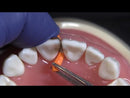 Garrison Fusion™ Anterior Matrix Bands