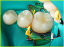 Garrison Composi-Tight® 3D Fusion™ Interproximal Wedge Refills - Dentsupply SIA