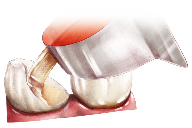 Arkona Comcord Dental Fibres