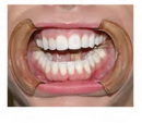 Close-up of a person's mouth with dental retractors on a plain background
