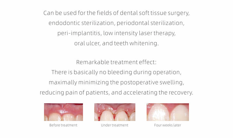 Laser LX16. A New Generation of High Power Dental Diode Laser - Dentsupply SIA