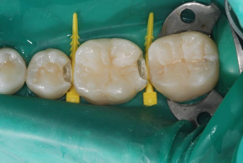  Interproximal Wedge Refills