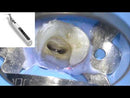 E-Connect S with built in apex locator by eighteeth, retreatment case